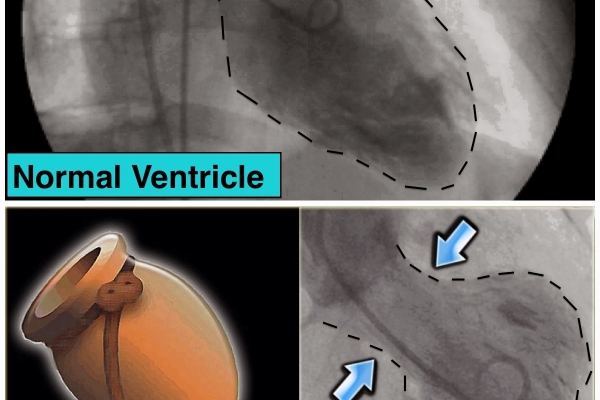 Vén tấm màn bí ẩn của hội chứng 'tan vỡ trái tim' liên quan đến bệnh lý tim mạch