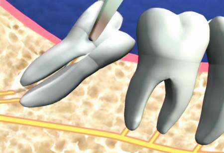 Biến chứng do răng khôn gây nên có thể gây dắt thức ăn và làm sâu răng