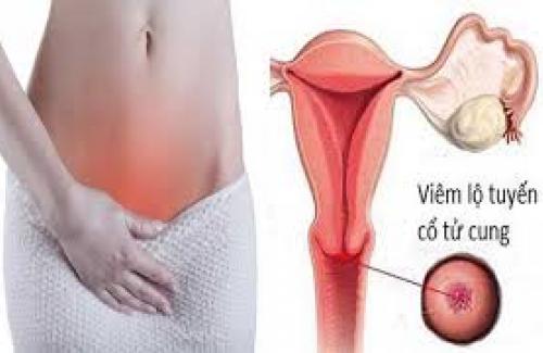 Nguyên nhân của viêm lộ tuyến cổ tử cung thường thấy là gì?