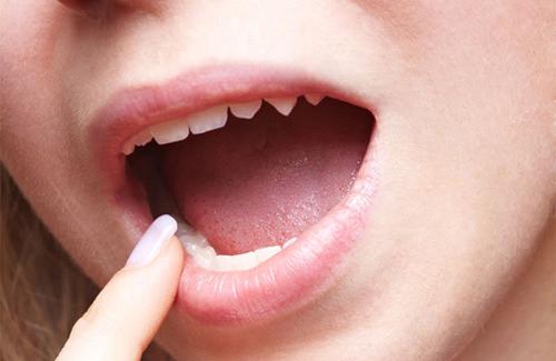 Nhiệt miệng là dấu hiệu của bệnh gì, ảnh hưởng tới sức khỏe như thế nào?