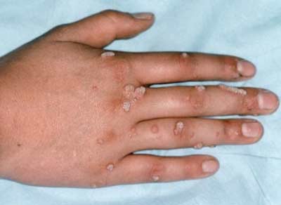 Điều trị mụn cóc bằng đốt điện liệu có an toàn đối với da?
