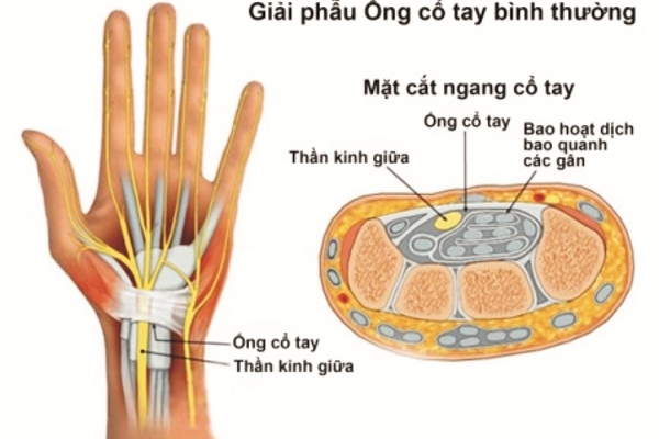 Nguyên nhân và cách chẩn đoán hội chứng ống cổ tay