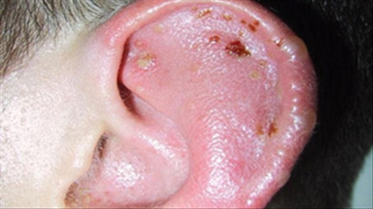 ok:Nổi ban ngứa có phải là dấu hiệu bị bệnh chàm vành tai