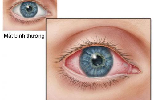 Ngăn ngừa và điều trị bệnh viêm mắt, viêm mũi dị ứng hiệu quả
