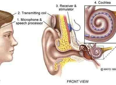 ok: Bị điếc liệu có chữa được không, đeo máy trợ thính có cải thiện tình hình?