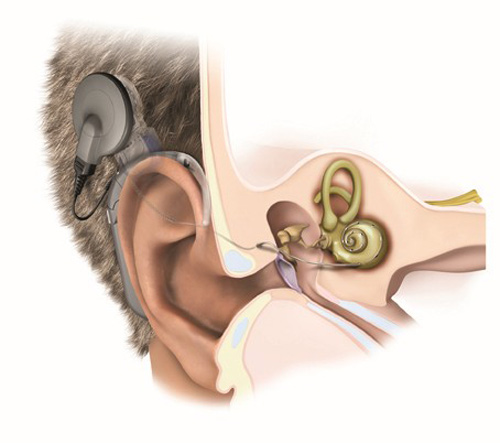 ok: Khi cấy ốc tai điện tử, người câm điếc có thể giao tiếp lưu loát?
