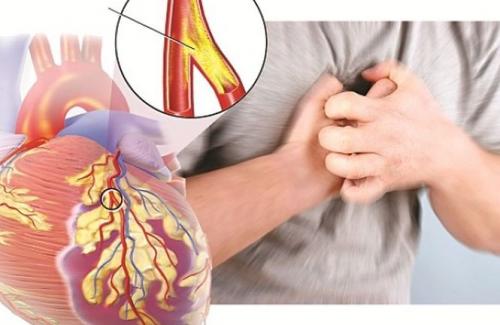 ok:Khi bị tắc nghẽn động mạch vành có nên đặt stent động mạch vành?