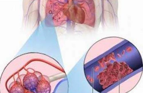 Tắc động mạch phổi - Nguyên nhân và hướng điều trị
