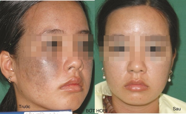 Điều trị bớt sắc tố da bẩm sinh và nám da như thế nào?