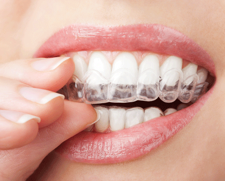 Tật nghiến răng và hậu quả nặng nề mà thói quen này gây ra