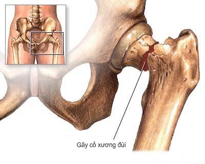 Một số giải pháp tối ưu nhất khi bị gãy cổ xương đùi