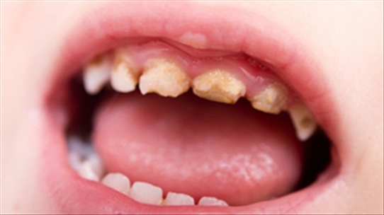 BS Nguyễn Thị Hòa: Khi nào thì cần nhổ bỏ răng sâu để tránh tình trạng xấu sảy ra?
