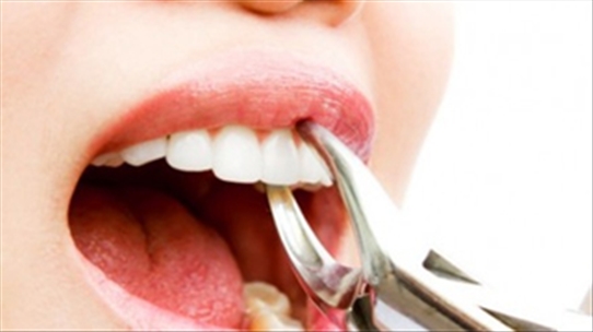 Chuyên gia nha khoa: Nhổ răng sâu để điều trị tận gốc là một quan niệm sai lầm