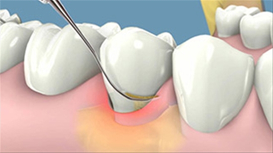 Vôi răng: Bao lâu nên lấy một lần để tránh làm hại men răng?