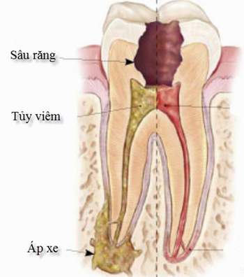 Phục hồi thân răng sau điều trị và những điều cần biết