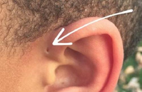 Điều trị rò trước tai như thế nào để có kết quả tốt nhất?