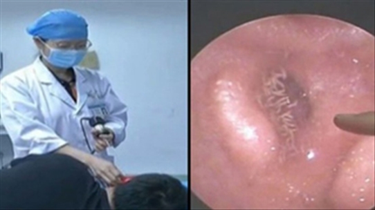 Kinh dị: Hình ảnh nội soi ấu trùng ruồi lúc nhúc trong tai