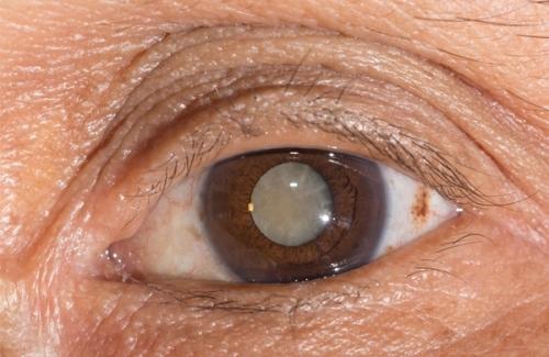 Biện pháp nào giúp điều trị hiệu quả đục nhân mắt?