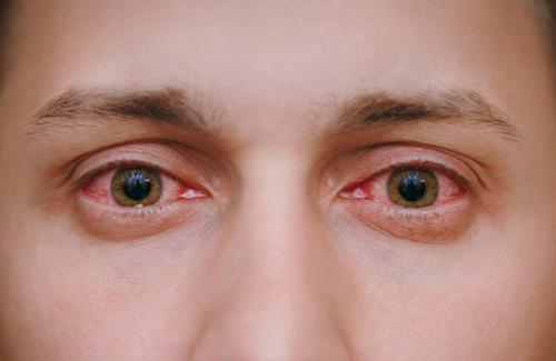 15 nguyên nhân khiến mắt bạn thường xuyên bị đỏ, hằn tia máu