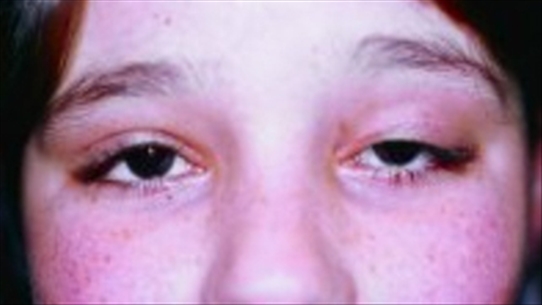 Dấu hiệu sớm của sa mí mắt và cách điều trị hiệu quả
