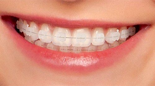 Niềng răng thẩm mỹ: Giải pháp tốt nhất cho răng lệch lạc