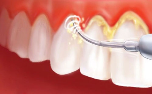 Ðổi màu răng và giải pháp cho răng trắng đẹp không thể bỏ qua