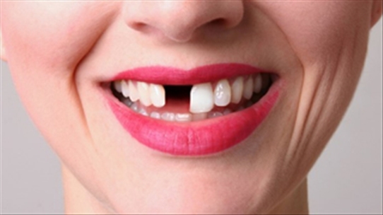 Sứt răng do ngã: Phải xử trí sao để có lại hàm răng trắng đẹp?