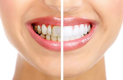 Tìm hiểu nguyên nhân và cách để bạn có hàm răng trắng đẹp mỗi ngày