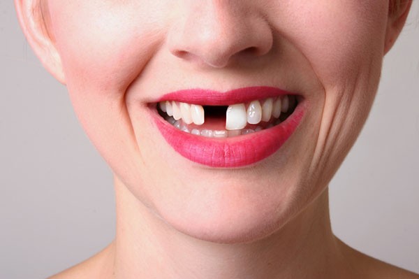 Hậu quả do mất răng đối với sức khỏe răng miệng nên chú ý