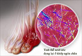 Tác hại khi acid uric máu tăng cao và cách phòng ngừa