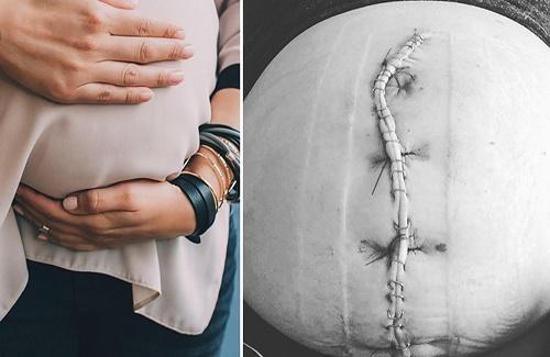 17 sự thật về quá trình mổ lấy thai mẹ nên biết khi chuẩn bị sinh mổ