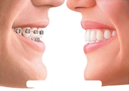 6 điều không thể bỏ qua khi niềng răng kẻo hại hàm răng