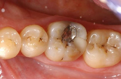 Có nên tự nhổ răng hàm hay không? Có nguy hiểm gì không?