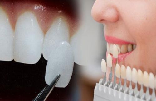 Những phương pháp hiệu quả để có hàm răng "đẹp như mơ"
