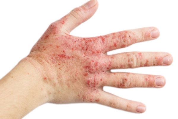 Những nguyên nhân cần cảnh giác với những vết bầm tím trên da