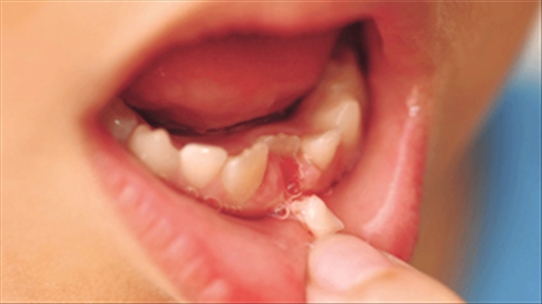 Bác sỹ nha khoa cảnh báo 2 trường hợp bố mẹ không nên tự nhổ răng sữa cho con tại nhà