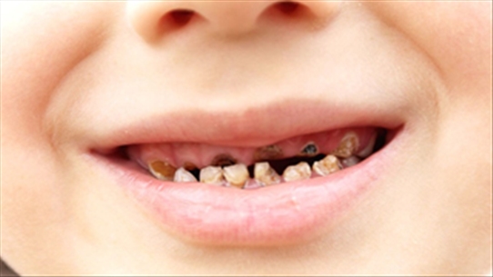 Cách đề phòng hiện tượng "răng biến mất" ở trẻ nhỏ