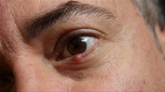 Chắp mắt có thể khởi phát cấp tính hoặc âm ỉ phải không?