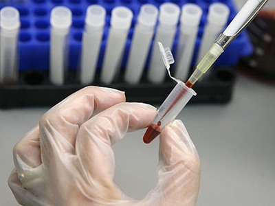 Xét nghiệm sinh hóa máu: Tìm hiểu kỹ để tránh lo âu
