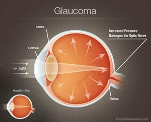 Biện pháp để nhận biết Glaucoma sớm để tránh mù lòa