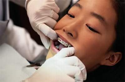 Điều cần biết khi chỉnh nha cho trẻ để việc chăm sóc răng miệng tốt hơn