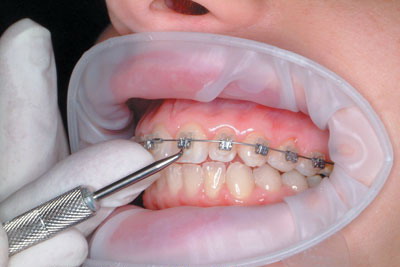 Tuổi nào thì nên đi khám? Nắn chỉnh răng có giới hạn tuổi không?