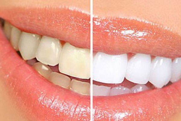 Các phương pháp tẩy trắng răng và lưu ý khi thực hiện