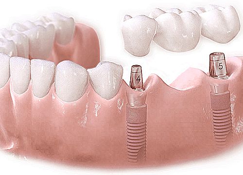 Bị mất răng - nên cấy ghép implant hay trồng răng sứ?