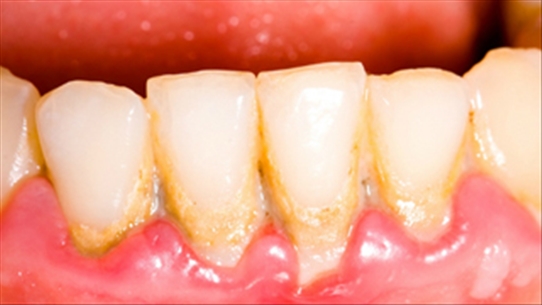 Nguy hiểm ít biết của vôi răng cần cẩn thận đề phòng