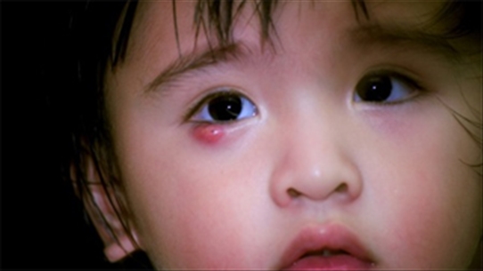 Cách đối phó lẹo mắt ở trẻ nhỏ đơn giản nhưng vô cùng hiệu quả