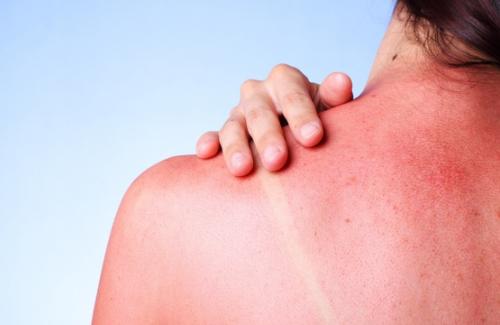 Chuyên gia da liễu giải thích ngộ độc nắng là gì, triệu chứng, cách khắc phục và ngăn ngừa