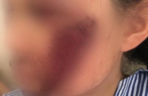 Nữ sinh tổn thương mặt nghiêm trọng, bác sĩ cảnh báo mối nguy từ áo chống nắng
