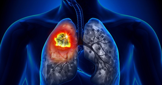 Người đàn ông được phát hiện ung thư phổi sau 10 ngày ho