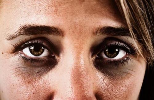 Xuất hiện quầng thâm ở mắt đừng chủ quan, rất có thể bạn đã mắc 1 trong 5 bệnh nguy hiểm này